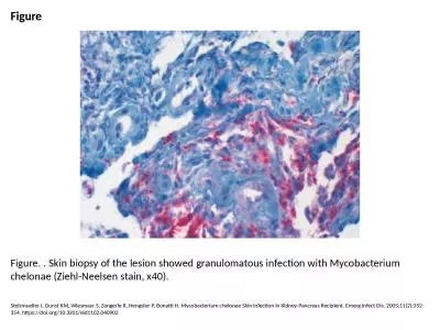 Figure Figure. . Skin biopsy of the lesion showed granulomatous infection with Mycobacterium