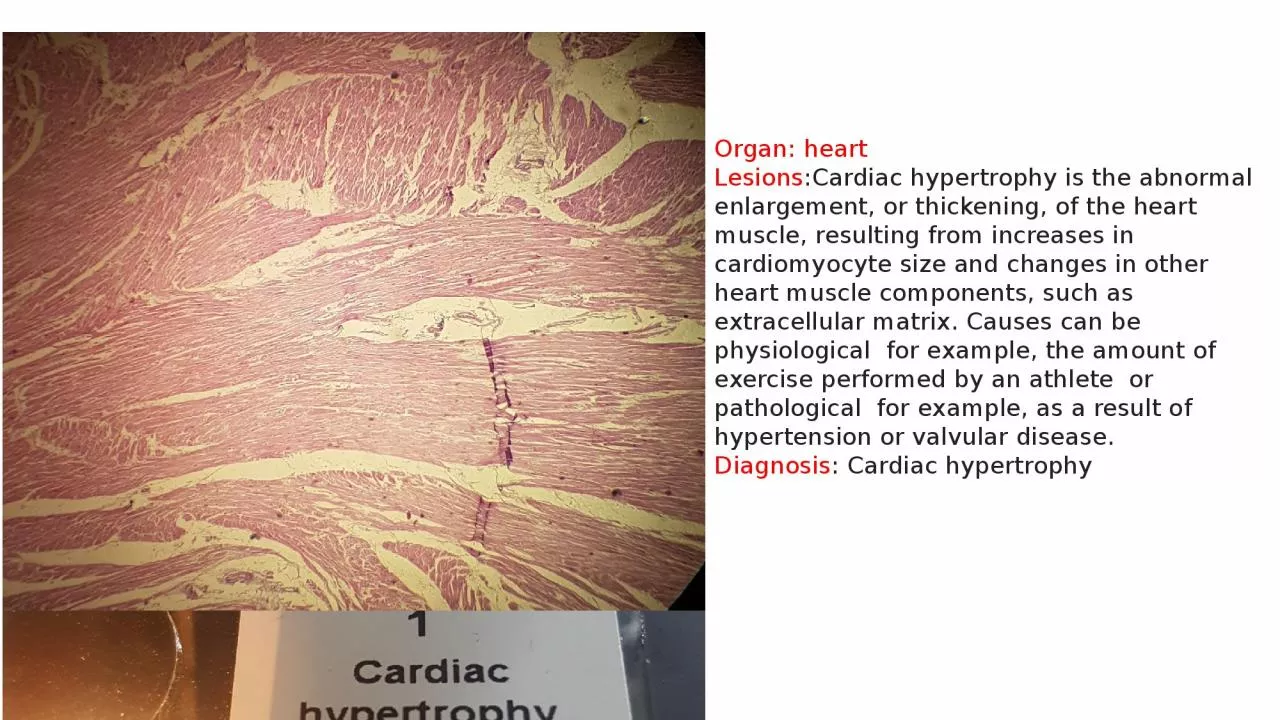 Organ: heart Lesions :Cardiac