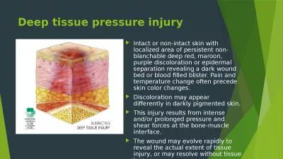 Deep tissue pressure injury