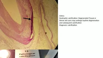 Artery    Dystrophic  calcification: Degenerated Tissues • Dense old scars may undergo