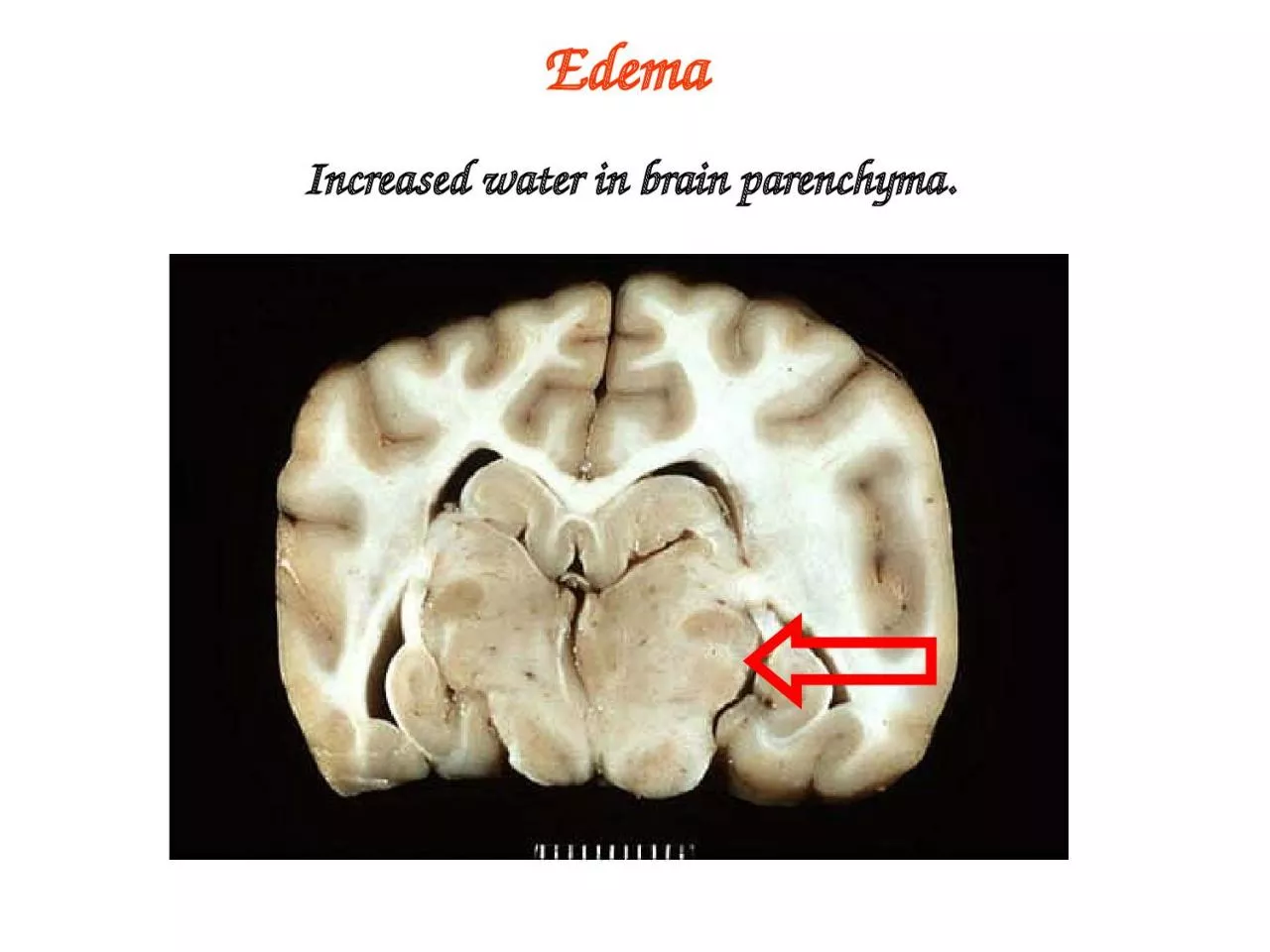 PPT-Edema Increased water in brain parenchyma.