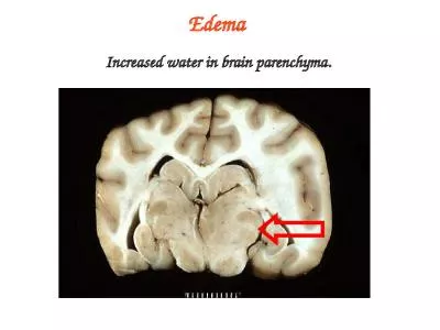 Edema Increased water in brain parenchyma.