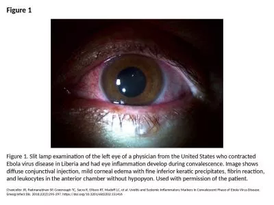 Figure 1 Figure 1. Slit lamp examination of the left eye of a physician from the United