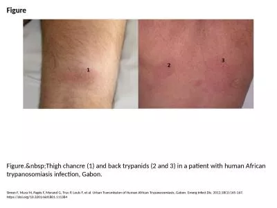 Figure Figure.&nbsp;Thigh chancre (1) and back trypanids (2 and 3) in a patient with