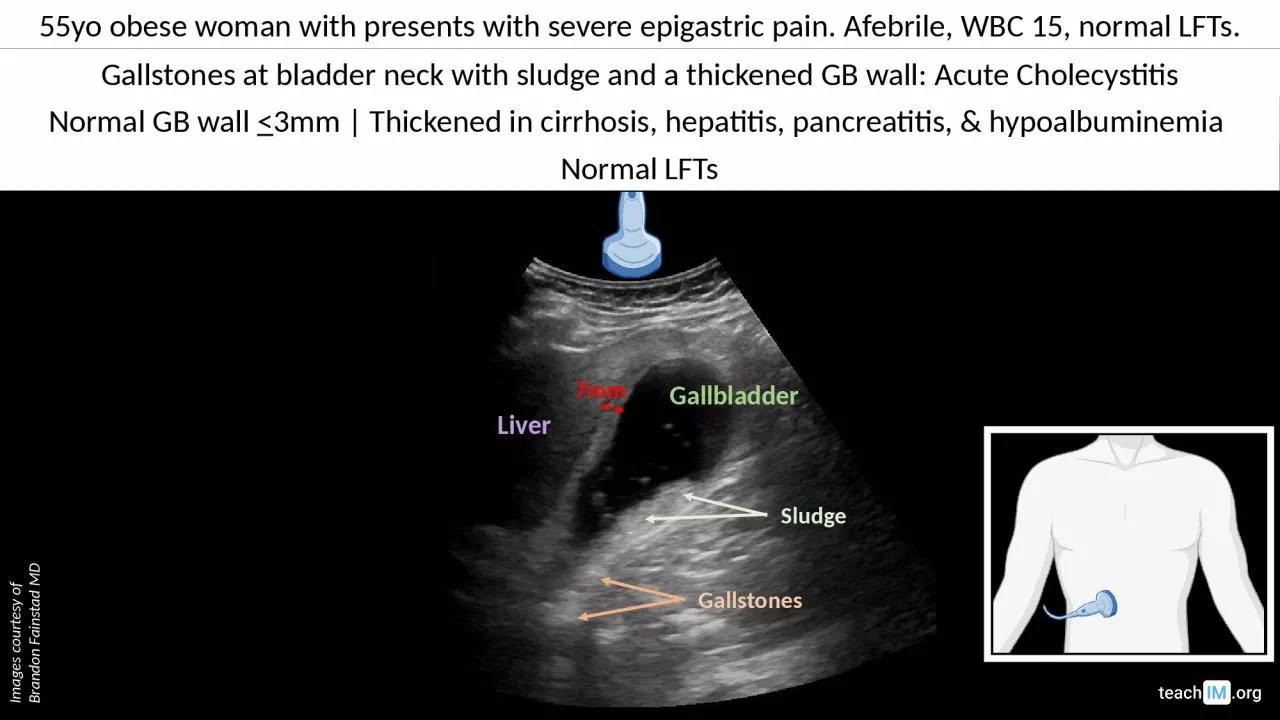 PPT-55yo obese woman with presents with severe epigastric pain. Afebrile, WBC 15, normal LFTs.