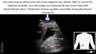 55yo obese woman with presents with severe epigastric pain. Afebrile, WBC 15, normal LFTs.