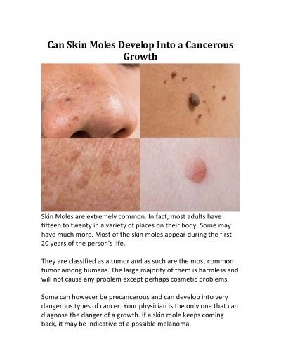 Can Skin Moles Develop Into a Cancerous Growth