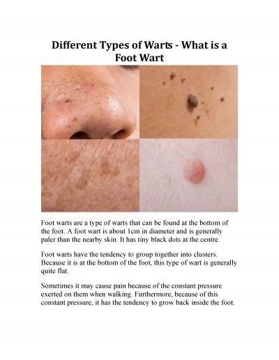 Different Types of Warts - What is a Foot Wart