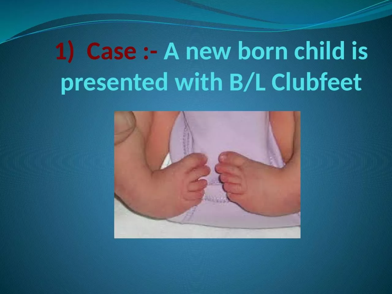 1)  Case :-  A new born child is presented with B/L Clubfeet