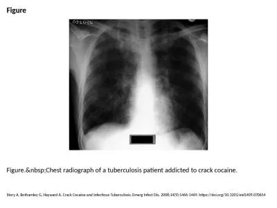 Figure Figure.&nbsp;Chest radiograph of a tuberculosis patient addicted to crack cocaine.