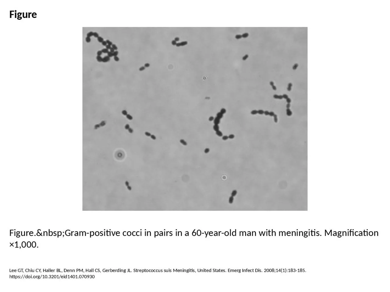 Figure Figure.&nbsp;Gram-positive cocci in pairs in a 60-year-old man with meningitis.