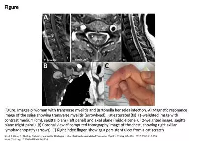 Figure Figure. Images of woman with transverse myelitis and Bartonella henselea infection.