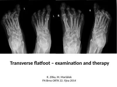 Transverse   flatfoot  –
