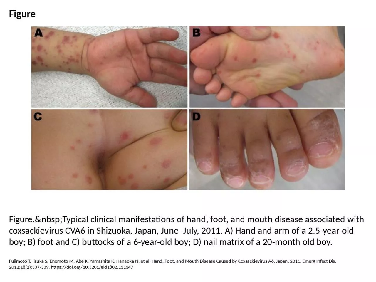 Figure Figure.&nbsp;Typical clinical manifestations of hand, foot, and mouth disease
