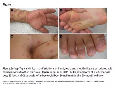 Figure Figure.&nbsp;Typical clinical manifestations of hand, foot, and mouth disease associated