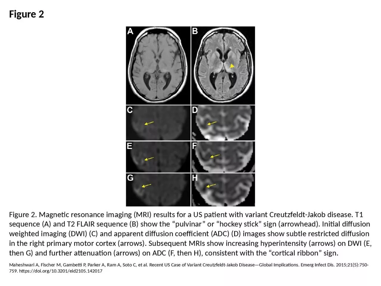 Figure 2 Figure 2. Magnetic resonance imaging (MRI) results for a US patient with variant