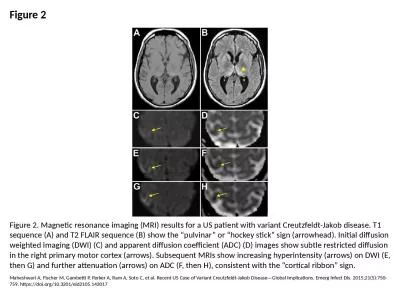 Figure 2 Figure 2. Magnetic resonance imaging (MRI) results for a US patient with variant Creutzfel