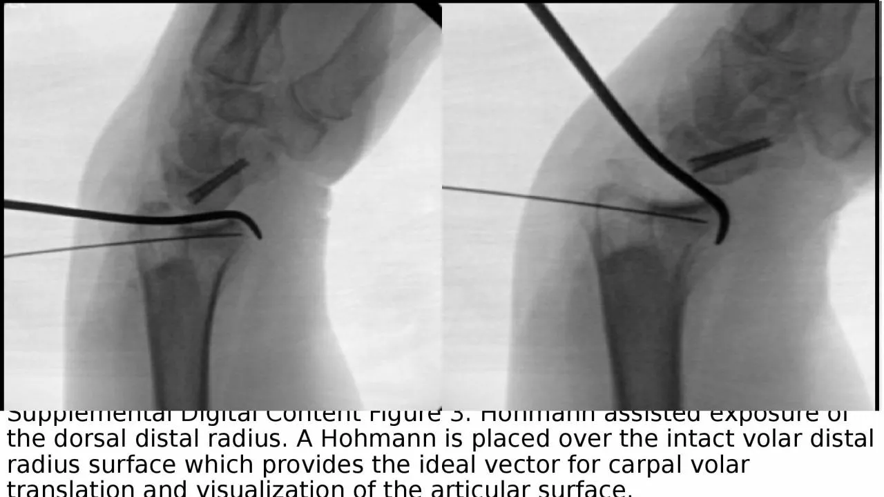 Supplemental Digital Content Figure 3. Hohmann assisted exposure of the dorsal distal