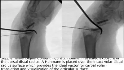 Supplemental Digital Content Figure 3. Hohmann assisted exposure of the dorsal distal radius. A Hoh