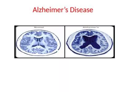 Alzheimer’s Disease 	 Alzheimer's