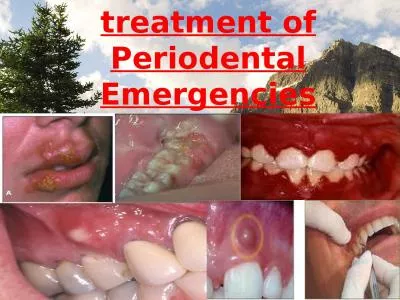 treatment of  Periodental