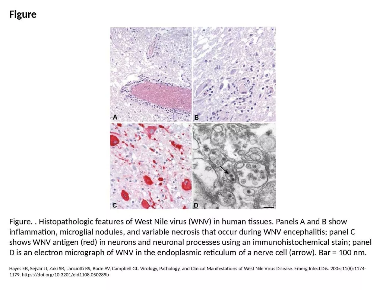 Figure Figure. . Histopathologic features of West Nile virus (WNV) in human tissues. Panels