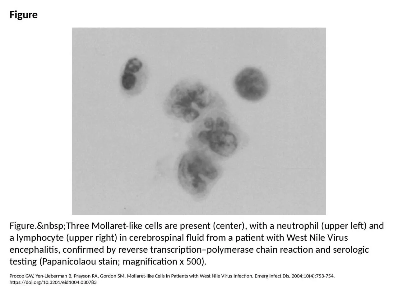 Figure Figure.&nbsp;Three Mollaret-like cells are present (center), with a neutrophil