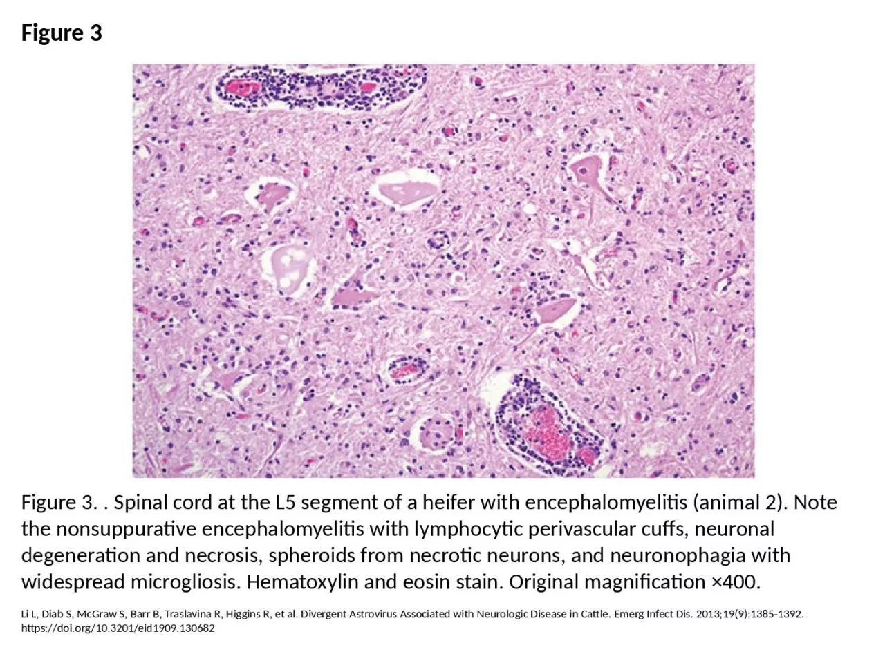 Figure 3 Figure 3. . Spinal cord at the L5 segment of a heifer with encephalomyelitis