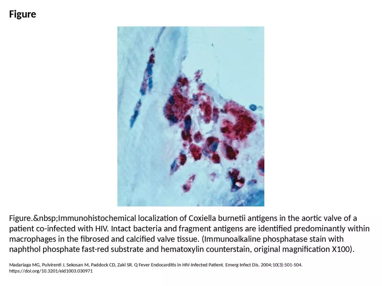 Figure Figure.&nbsp;Immunohistochemical localization of Coxiella burnetii antigens