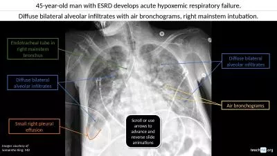 45-year-old man with ESRD develops acute hypoxemic respiratory failure.