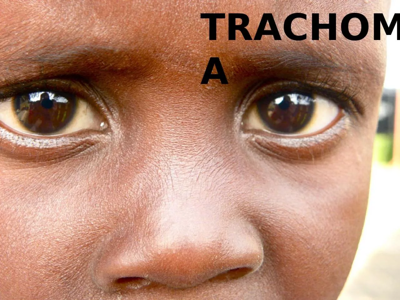 TRACHOMA Trachoma (granular