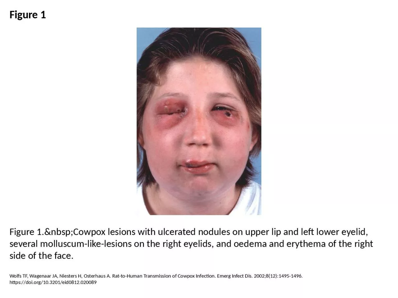 Figure 1 Figure 1.&nbsp;Cowpox lesions with ulcerated nodules on upper lip and left