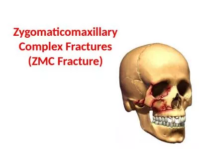 Zygomaticomaxillary  Complex Fractures (ZMC Fracture)