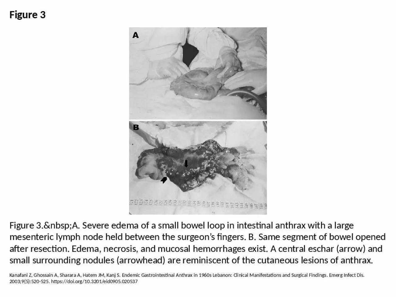 PPT-Figure 3 Figure 3.&nbsp;A. Severe edema of a small bowel loop in intestinal anthrax