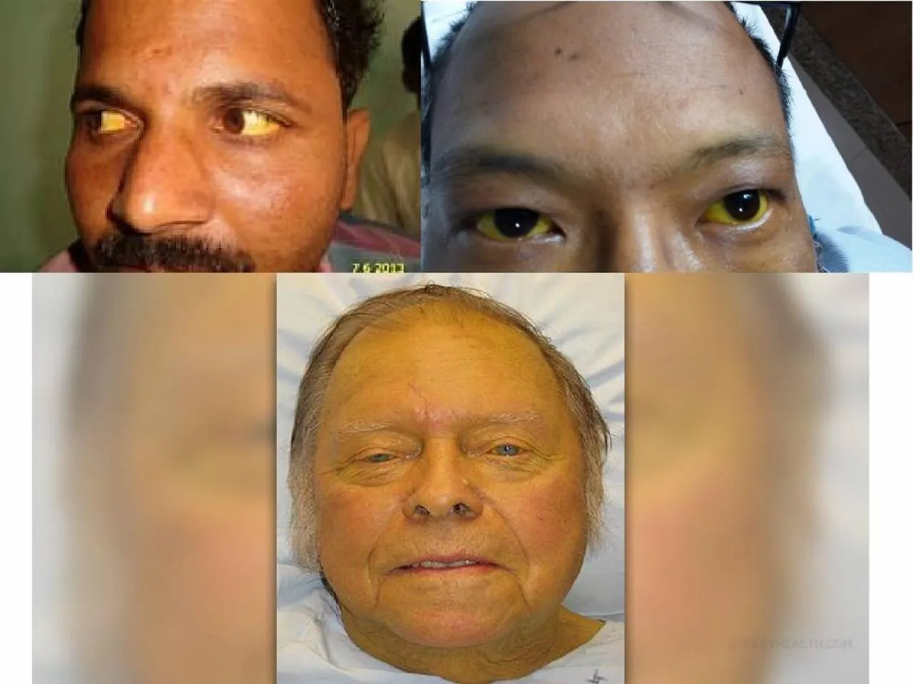 PPT-Jaundice is a condition in which the skin, sclera (whites of the eyes) and mucous membranes