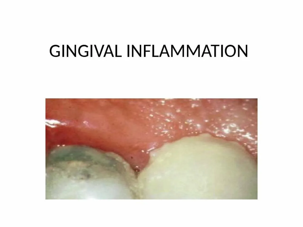 PPT-GINGIVAL INFLAMMATION INTRODUCTION