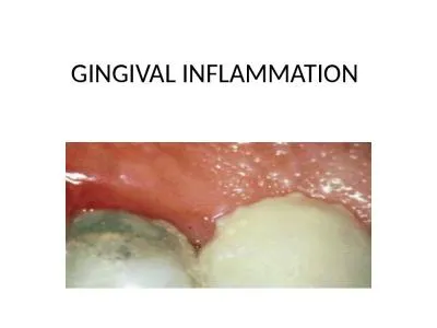 GINGIVAL INFLAMMATION INTRODUCTION