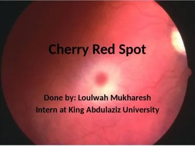 Cherry Red Spot Done by: Loulwah