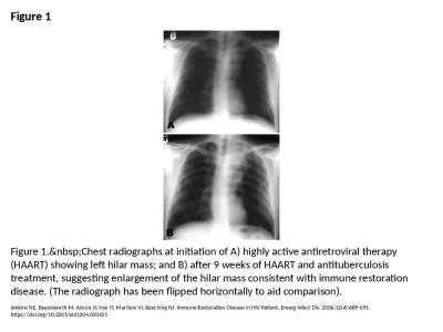 Figure 1 Figure 1.&nbsp;Chest radiographs at initiation of A) highly active antiretroviral ther