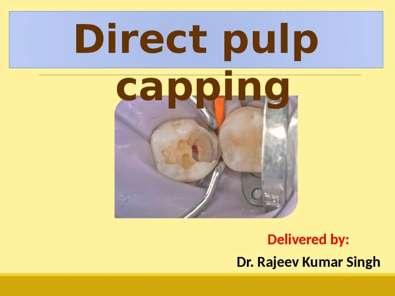 PPT-Direct pulp capping Delivered by: