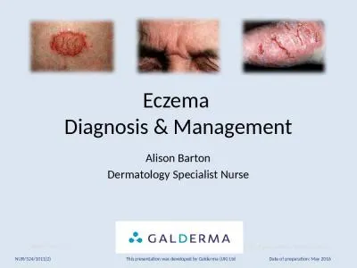 Eczema  Diagnosis & Management