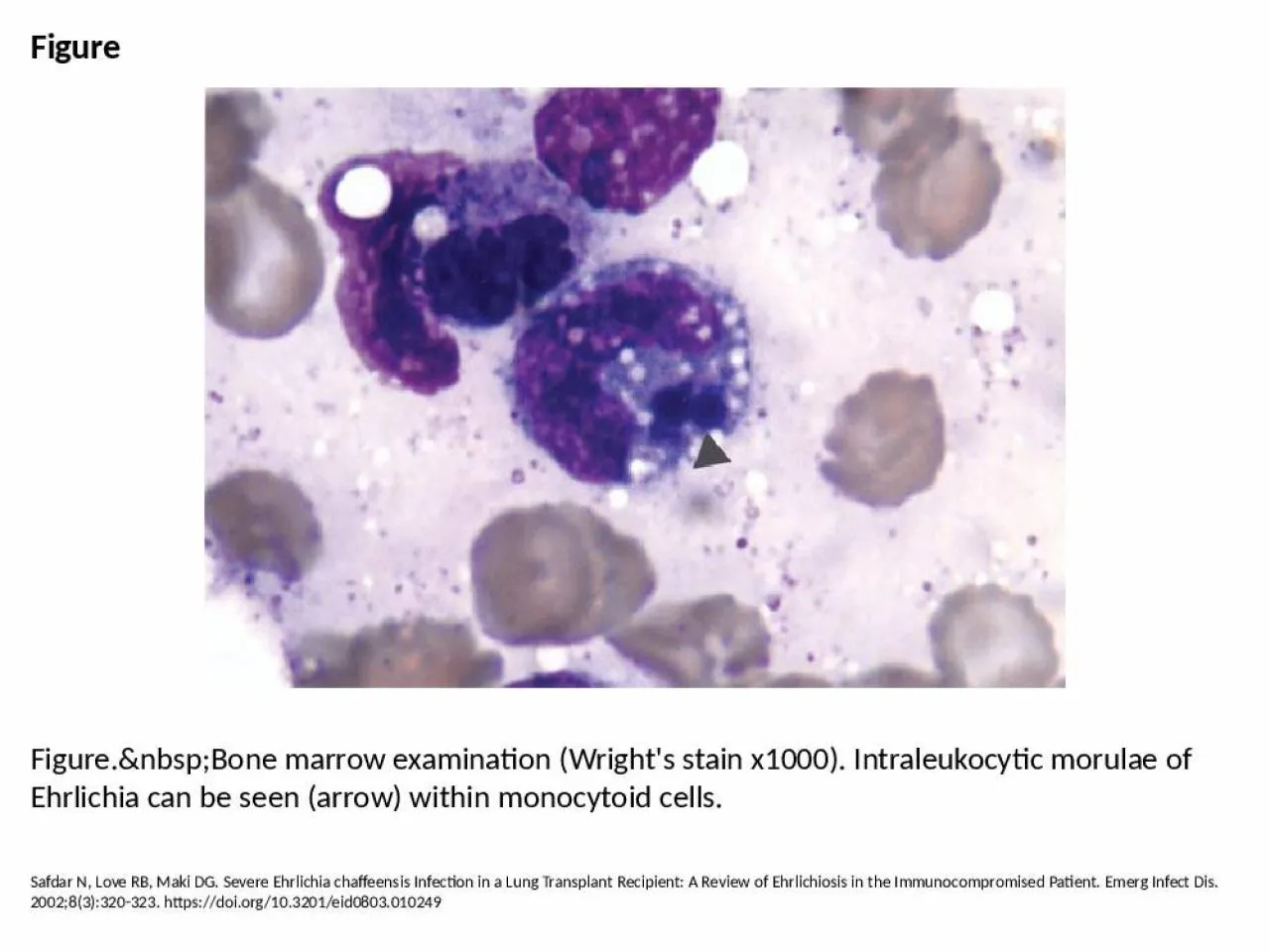 PPT-Figure Figure.&nbsp;Bone marrow examination (Wright's stain x1000). Intraleukocytic