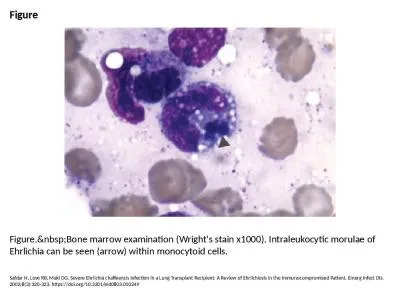 Figure Figure.&nbsp;Bone marrow examination (Wright's stain x1000). Intraleukocytic morulae of