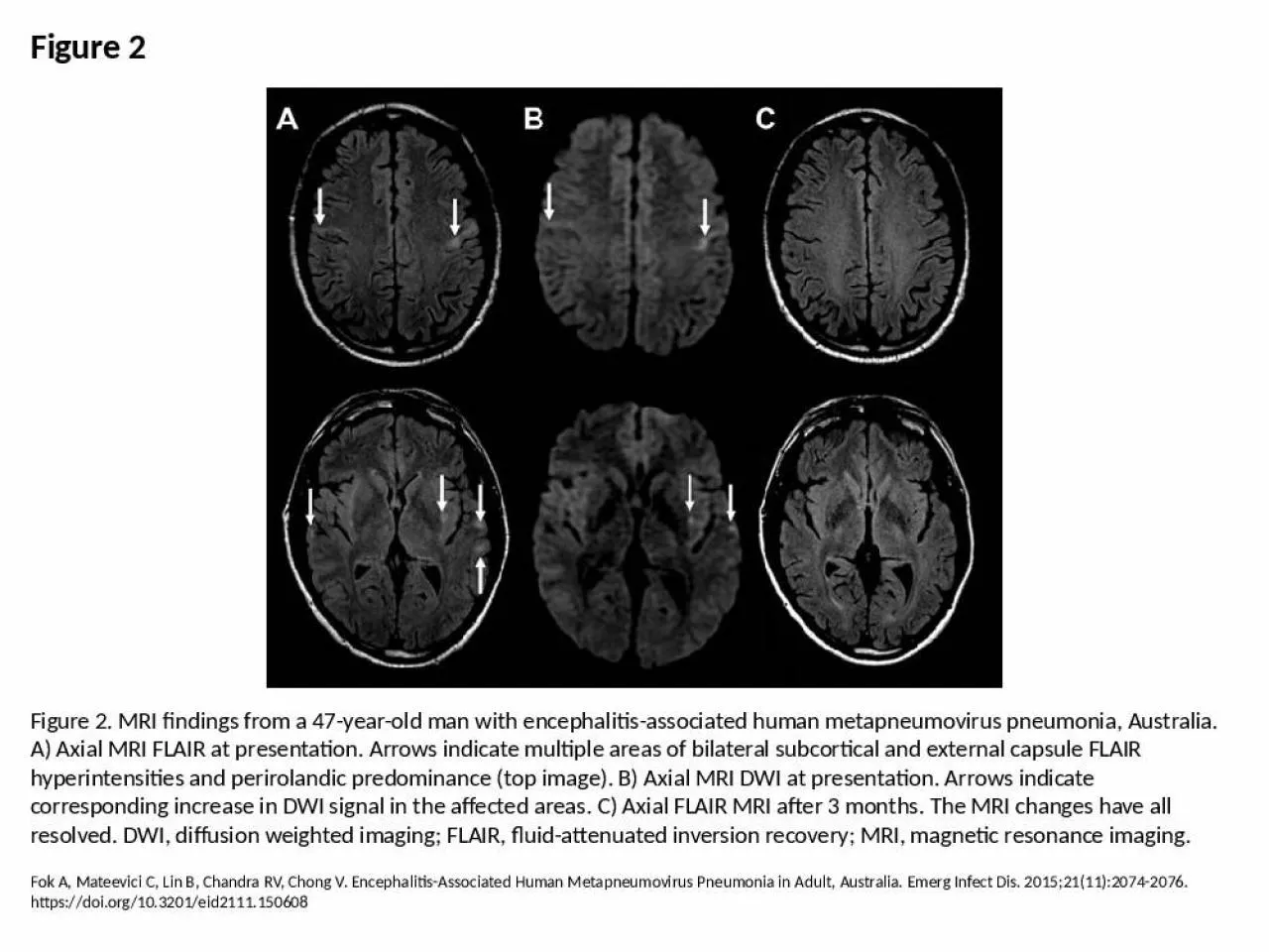 PPT-Figure 2 Figure 2. MRI findings from a 47-year-old man with encephalitis-associated human