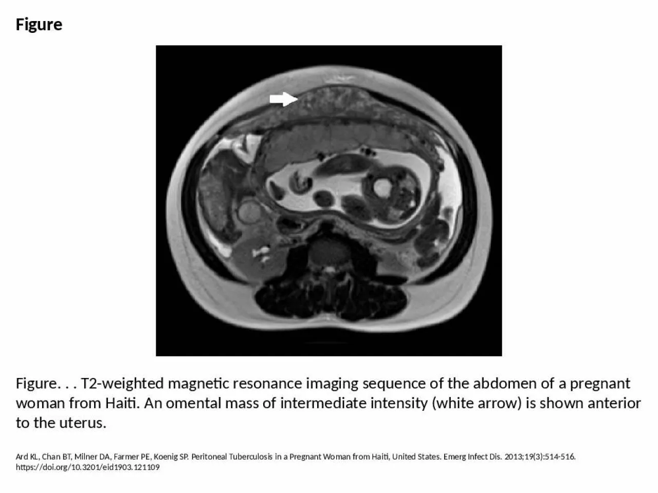 PPT-Figure Figure. . . T2-weighted magnetic resonance imaging sequence of the abdomen of a