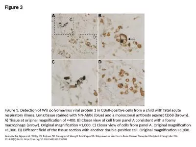 Figure 3 Figure 3. Detection of WU polyomavirus viral protein 1 in CD68-positive cells