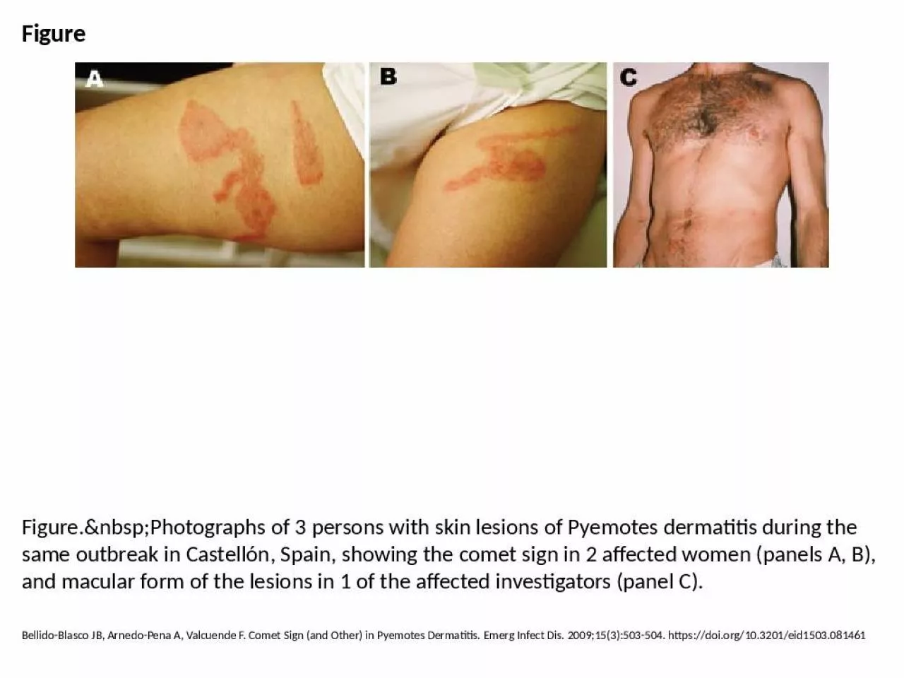 PPT-Figure Figure.&nbsp;Photographs of 3 persons with skin lesions of Pyemotes dermatitis