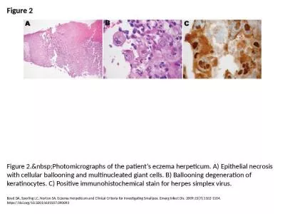 Figure 2 Figure 2.&nbsp;Photomicrographs of the patient’s eczema herpeticum. A)