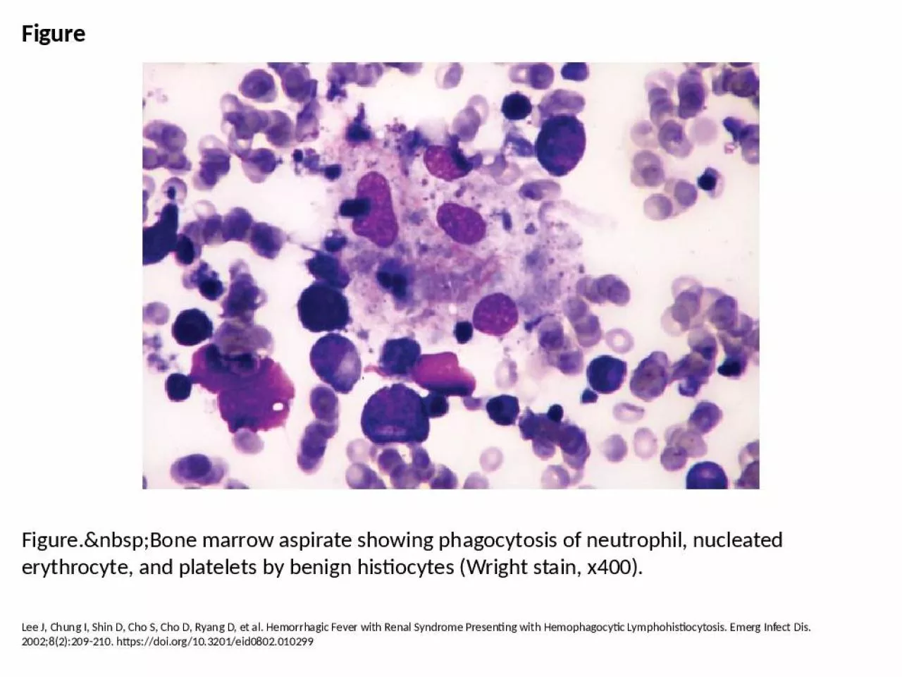 PPT-Figure Figure.&nbsp;Bone marrow aspirate showing phagocytosis of neutrophil, nucleated