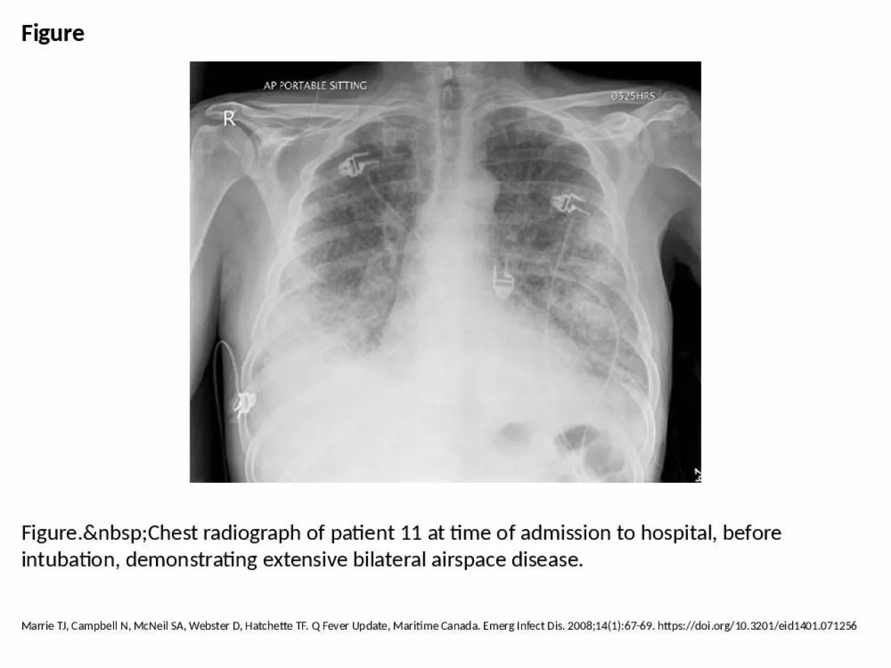 PPT-Figure Figure.&nbsp;Chest radiograph of patient 11 at time of admission to hospital,